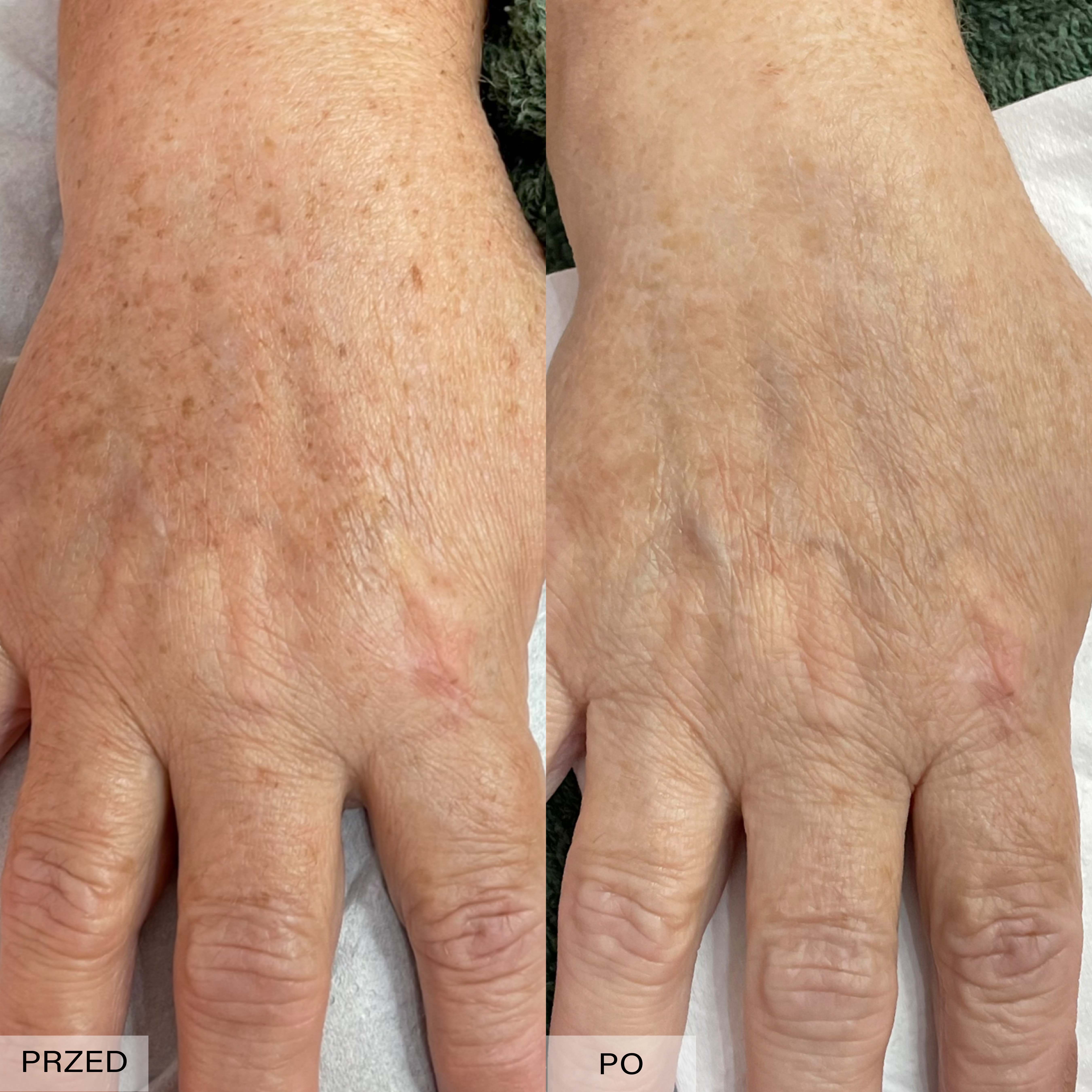 fototerapia ipl efekty